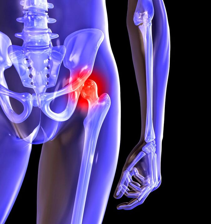 Deforming Arthrosis vum Hip Joint