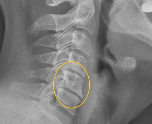 Osteochondrosis vun der Gebärmutteralpräif op enger X -ray