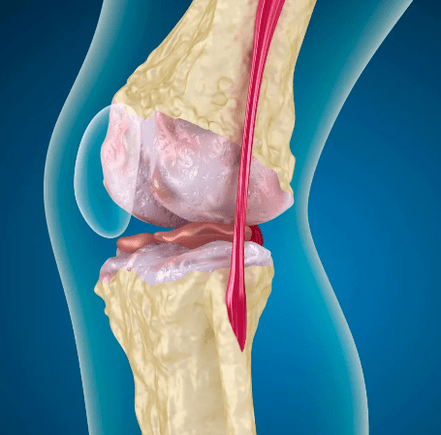 Arthronose vum Knéi Gelenk