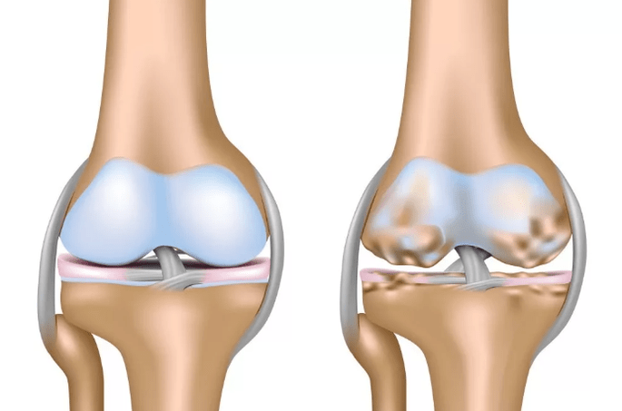 Deforming Arthrosis vum Knéi Gelenk