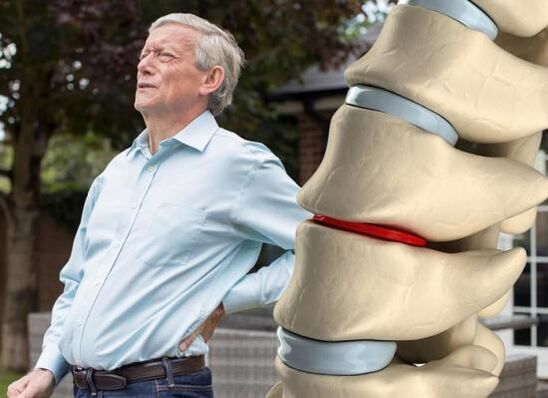 Osteochondrose beaflosst d'intervertebrale Scheiwen a verursaacht Réckschmerzen