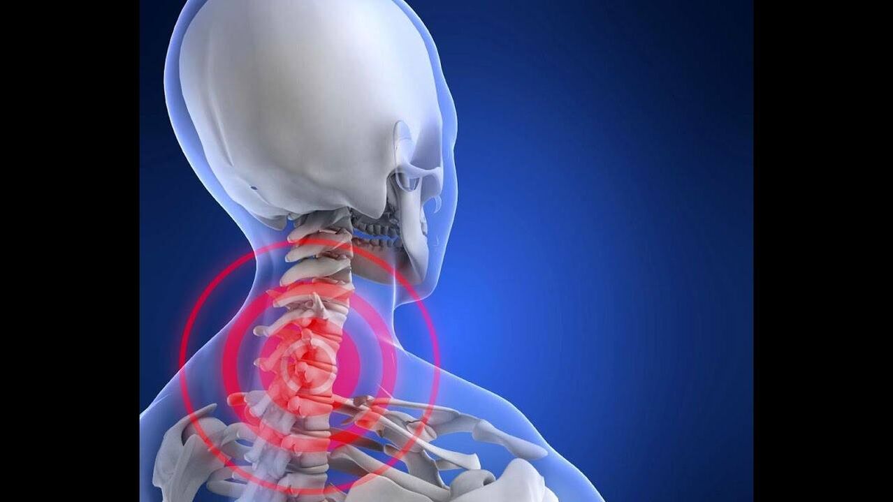 Osteochondrose vun der cervical Wirbelsäule