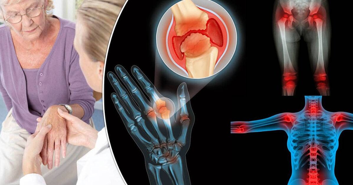 wat ass Arthrosis